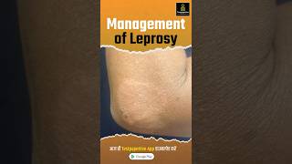 Management of Leprosy  Treatment Prevention Leprosy management treatment shortvideo nursing [upl. by Waterer]