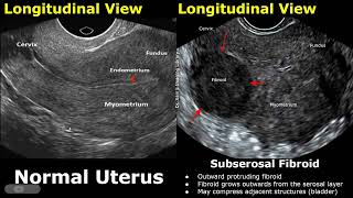 Uterus Ultrasound Normal Vs Subserosal Fibroid Images  Uterine Leiomyomas Cases  Pelvic USG Cases [upl. by Mahau]