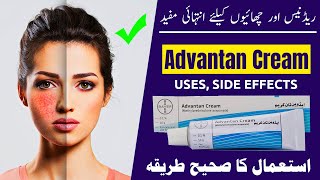 Advantan Cream Uses Benefits and Side Effects Discussed [upl. by Oijimer]