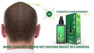 Green Wealth Neo Hair Lotion  3 Month Usage Progress [upl. by Bosch]