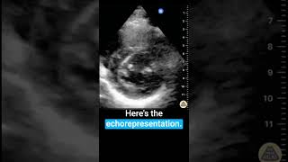 Learn parasternal short axis view [upl. by Aya]