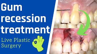 Gum recession surgery  Live Treatment Rotated Pedicle Flap [upl. by Audre]