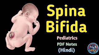 Spinal Bifida  Spinal Bifida in hindi  Spinal Bifida pediatric nursing  spinal bifida treatment [upl. by Lazos995]