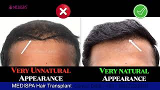 Hair Transplant Results looks UNNATURAL Correction of Bad Hair Transplant by Dr Suneet Soni [upl. by Eelah]