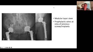 Conversion en Arthroplastie Totale de la Hanche Après un Traitement de Fracture de la Hanche Échoué [upl. by Sidoney196]