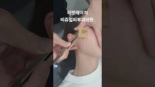 리팟 레이저 다발성 흑자 세종리팟 세종시리팟 reepot lentigo multiplelentigo 청주리팟 공주리팟 대전리팟 오창리팟 오송리팟 부여리팟 [upl. by Ojytteb]