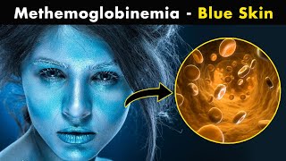 How Methemoglobinemia Effects our body UrduHindi [upl. by Felicidad]