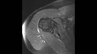 Glenoid hypoplasia and posterior labral tear [upl. by Allenrad]