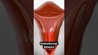 Using heated fluid to stop heavy periods 3D Animation [upl. by Hsot]