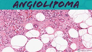 Angiolipoma 5Minute Pathology Pearls [upl. by Suoivart]