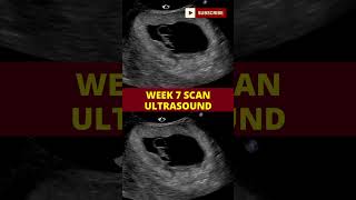 ultrasound scan week 7  pregnancy scan  week by week pregnancy [upl. by Annawal]