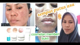 review cosmelan packselamat tinggal melasmaselamat tinggal flek hitam [upl. by Anairuy646]