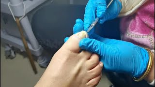 Pedicure painless nails removal Fungal nail treatment amp ingrown toenails removal [upl. by Nirro]