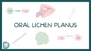 Oral Lichen Planus Causes Diagnosis Types and Management [upl. by Ynor]