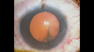 Smooth Phacoemulsification of Cortical Cataract by Dr Billal Hossain [upl. by Koller]