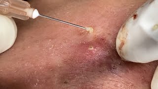 Big Cystic Acne Blackheads Extraction Blackheads amp Milia Whiteheads Removal Pimple Popping [upl. by Aneelehs]