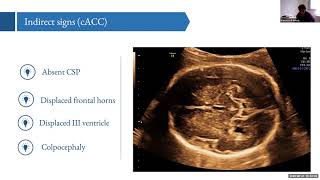 Corpus Callosum How easy diagnosis Francesco D’Antonio [upl. by Erdied]