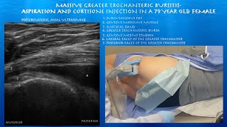 Ultrasound Guided Massive Greater Trochanteric Bursitis Aspiration and Injection by probeultrasound [upl. by Nosyd193]