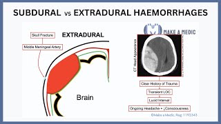 Subdural vs Extradural Haemorrhages Explained [upl. by Ramsay]