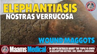 Elephantiasis Nostras Verrucosa and Wound Maggots  Rare Skin Disease [upl. by Branscum]