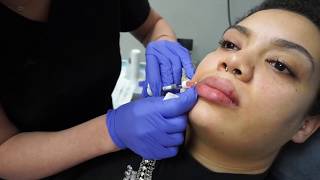 Lip Augmentation with 15ml of Restylane [upl. by Marshall]