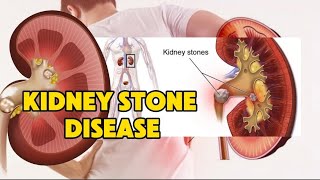 kidney stones disease  how to cure  precautions  types causes [upl. by Mohandis]