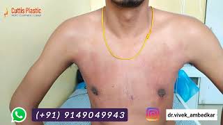 Gynecomastia Surgery Result  Lakhnow  Kanpur Banda Jhansi Panna  Firozabad Sikokabad [upl. by Nirro]