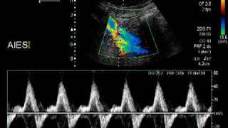 aortic dissection [upl. by Schifra]