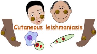 شرح cutaneous leishmaniasis [upl. by Ennairam]