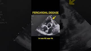 Pericardial Effusion pericardium pericarditis cardiomyopathy aorta atrialfibrillation aortic [upl. by Nnayelhsa]