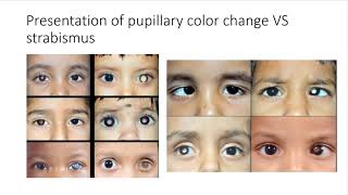 Retinoblastoma for medical students [upl. by Alsi]