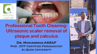 Ultrasonic scaling of teeth  Removal of dental calculus and plaque  Full mouth debridement [upl. by Treulich492]