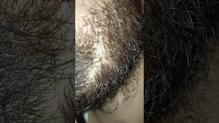 Ingrown hair longer satisfying ingrownhair hairstyle satisfyingviralshort viralshorts [upl. by Ajnot]