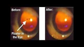 EYE FLOATERS  Cure  Treatment Naturally [upl. by Essirahc]