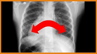 Primary Ciliary Dyskinesia Kartagener Syndrome vs Cystic Fibrosis [upl. by Sutsugua]