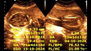 Routine antenatal ultrasound at 21 weeks gestation  Ultrasonography of a 21week pregnancy [upl. by Ginder]