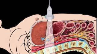 Introduction Abdominal Aorta Focused Ultrasound Examination [upl. by Corenda]