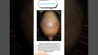 Finasteride for hair loss in androgenic alopecia [upl. by Aicena]