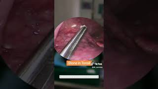 tonsil stones removal [upl. by Ahsieken250]