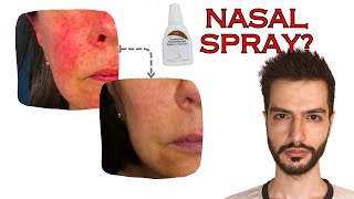 Rosacea Redness treatment with a Nasal Spray  Mo React [upl. by Ayortal]