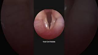 Pediatric Vocal Cord Nodules Development and Resolution Time Lapse [upl. by Langille]