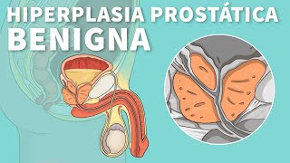 Hiperplasia prostática benigna Causas síntomas y tratamiento HPB  Stanford [upl. by Sherie802]