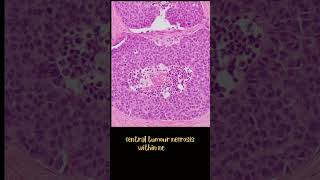 Medullary thyroid carcinoma [upl. by Cutlor489]