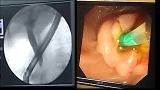 ERCP Metallic Stent Placement BDENDOSCOPY [upl. by Sloan]