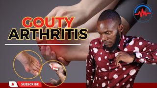 Gouty Arthritis Causes Symptoms and Treatment [upl. by Francisco]