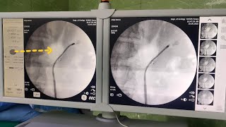 RIRS  Retrograde Intrarenal Surgery [upl. by Abil944]