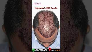 The Best Hair Transplant Results 4500 Grafts Grade 6 Baldness Dr Suneet Soni Medispa India [upl. by Ennoitna960]