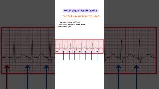 Focal Atrial Tachycardia ecg ecginterpretation medicine doctor nurse [upl. by Liebermann]