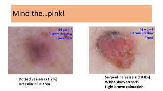 Dermatoscopic features of thin nodular melanoma  Dr Dimitris Sgouros [upl. by Macnamara]