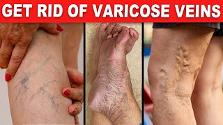 ಕಾಲಿನ ರಕ್ತನಾಳ ಹುಬ್ಬಿದ್ದರೆ ಪರಿಹಾರ Varicose Vein  10 Natural Ways Varicose Veins  Doctor Shiva [upl. by Arhsub]